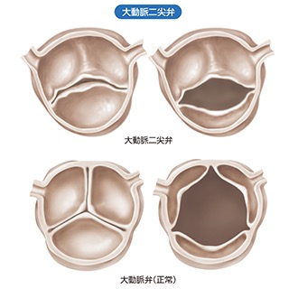 大動脈二尖弁と正常弁の比較図