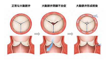 正常な大動脈弁/大動脈弁閉鎖不全症/大動脈弁形成術後